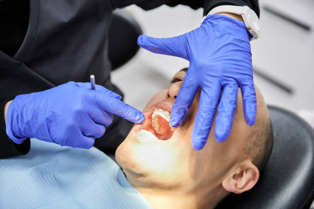Best Emergency Wisdom Tooth Extraction in Berkley, CO